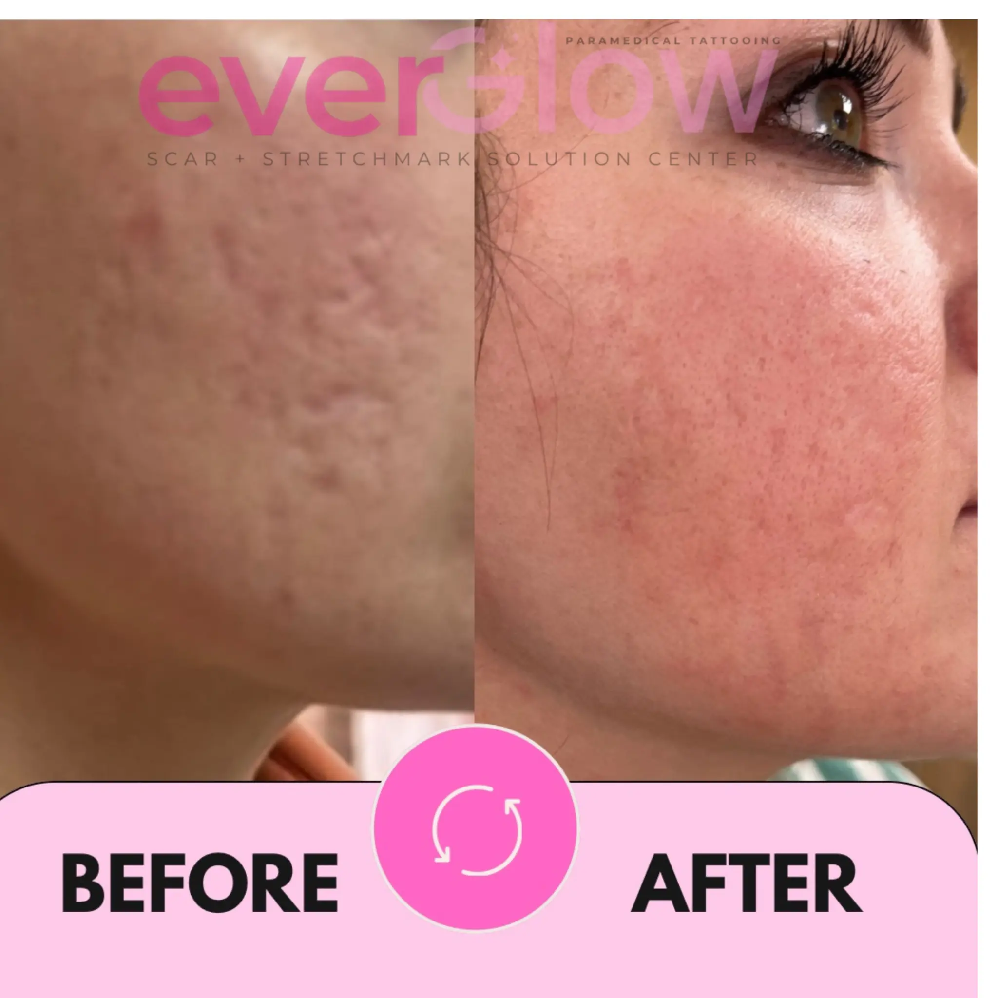 Acne scar treatment — before and after