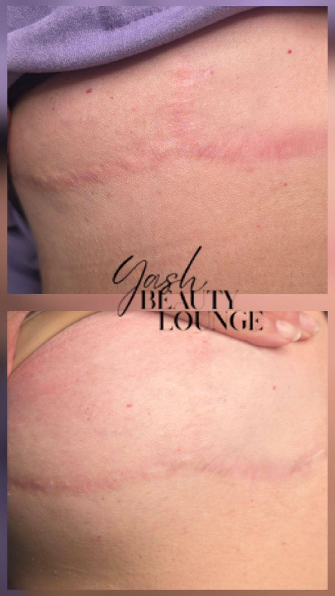 Back scar inkless revision — before and after