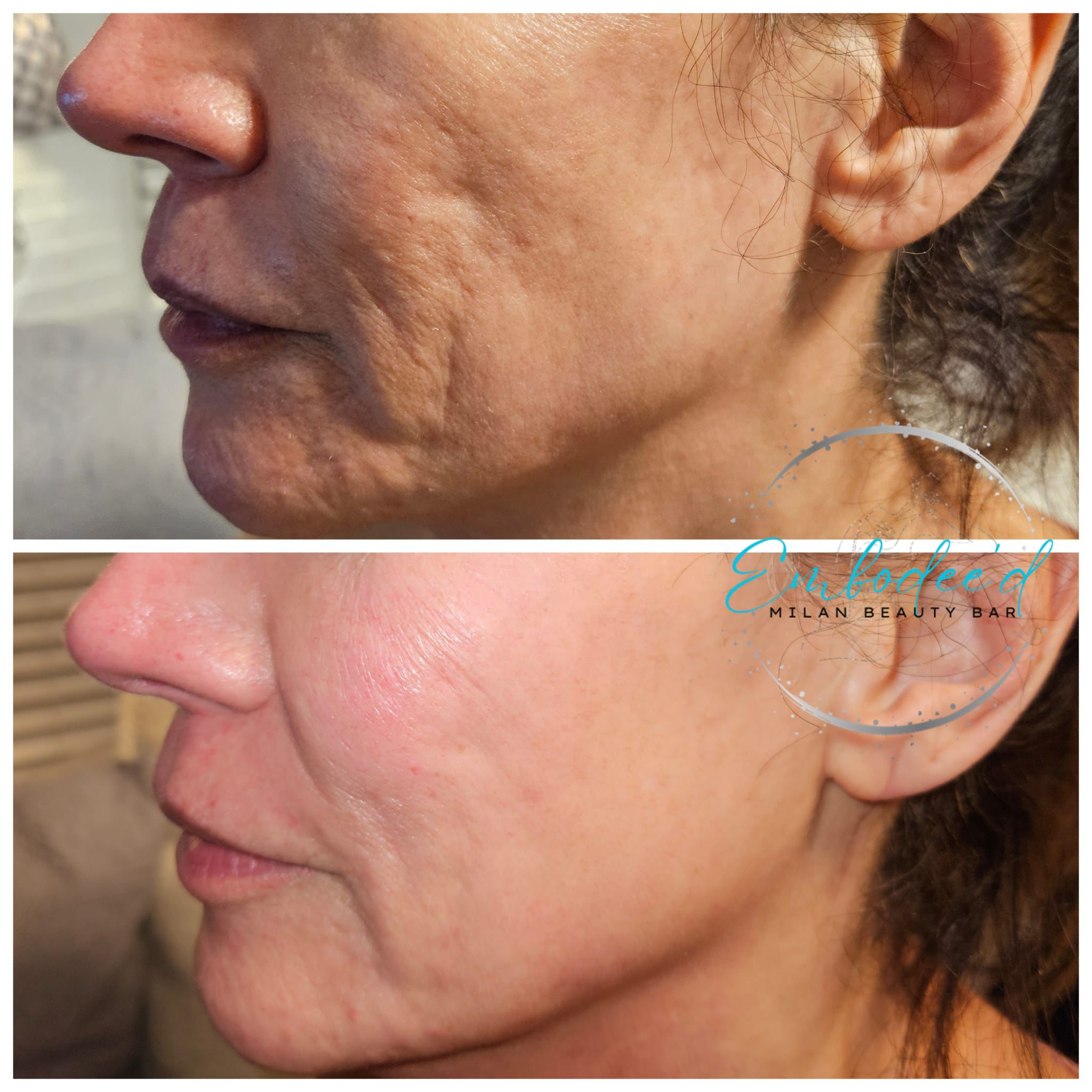 Cheek and jawline rejuvenation — before and after