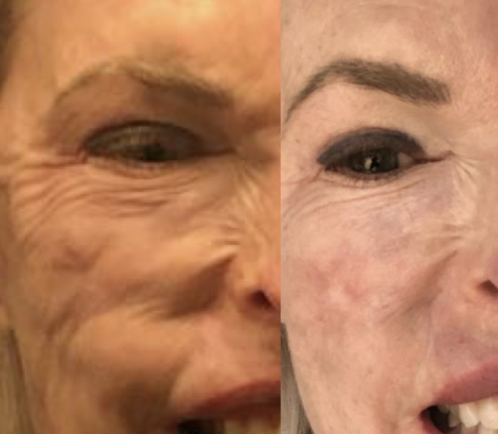 Facial rejuvenation inkless treatment — before and after