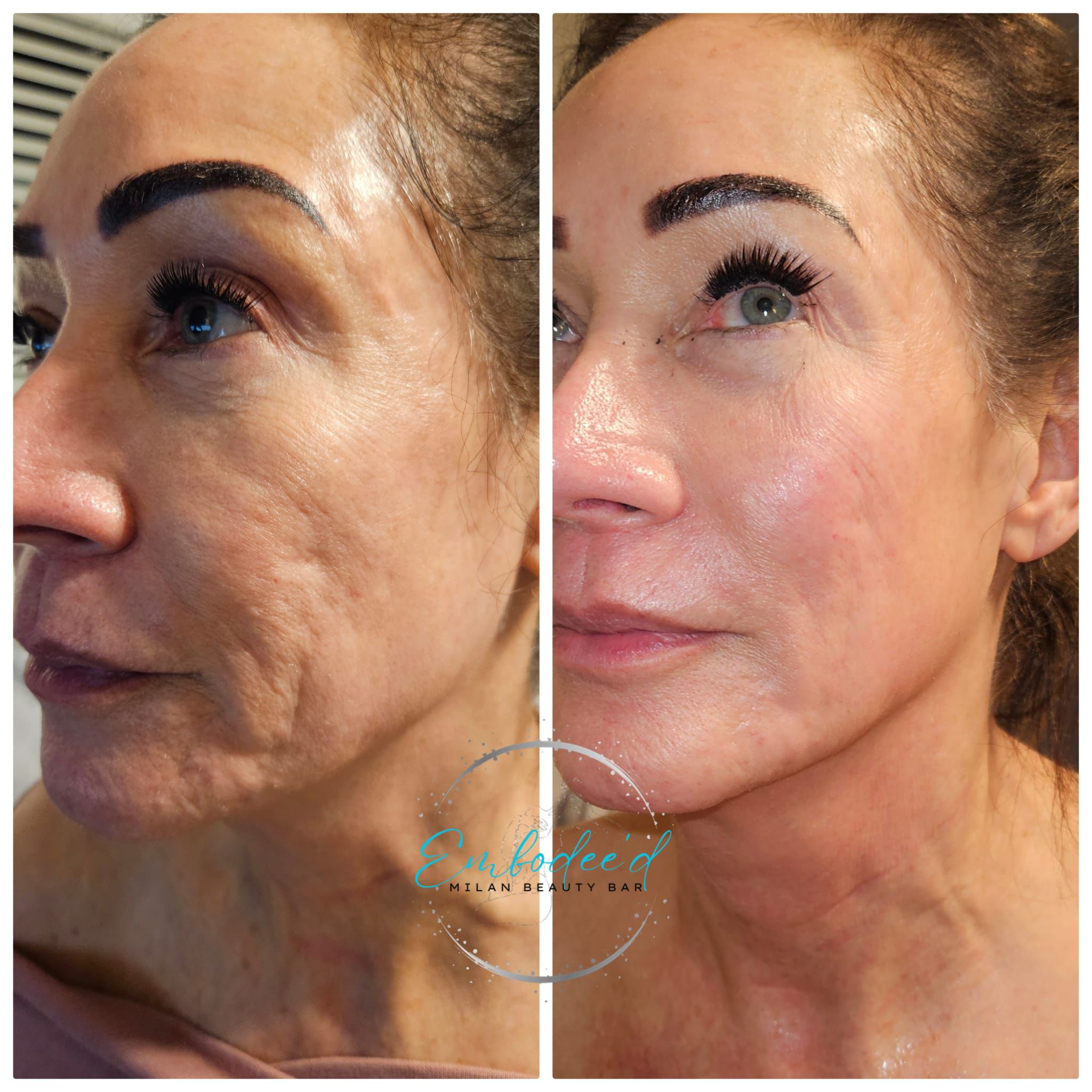 Facial skin rejuvenation — before and after