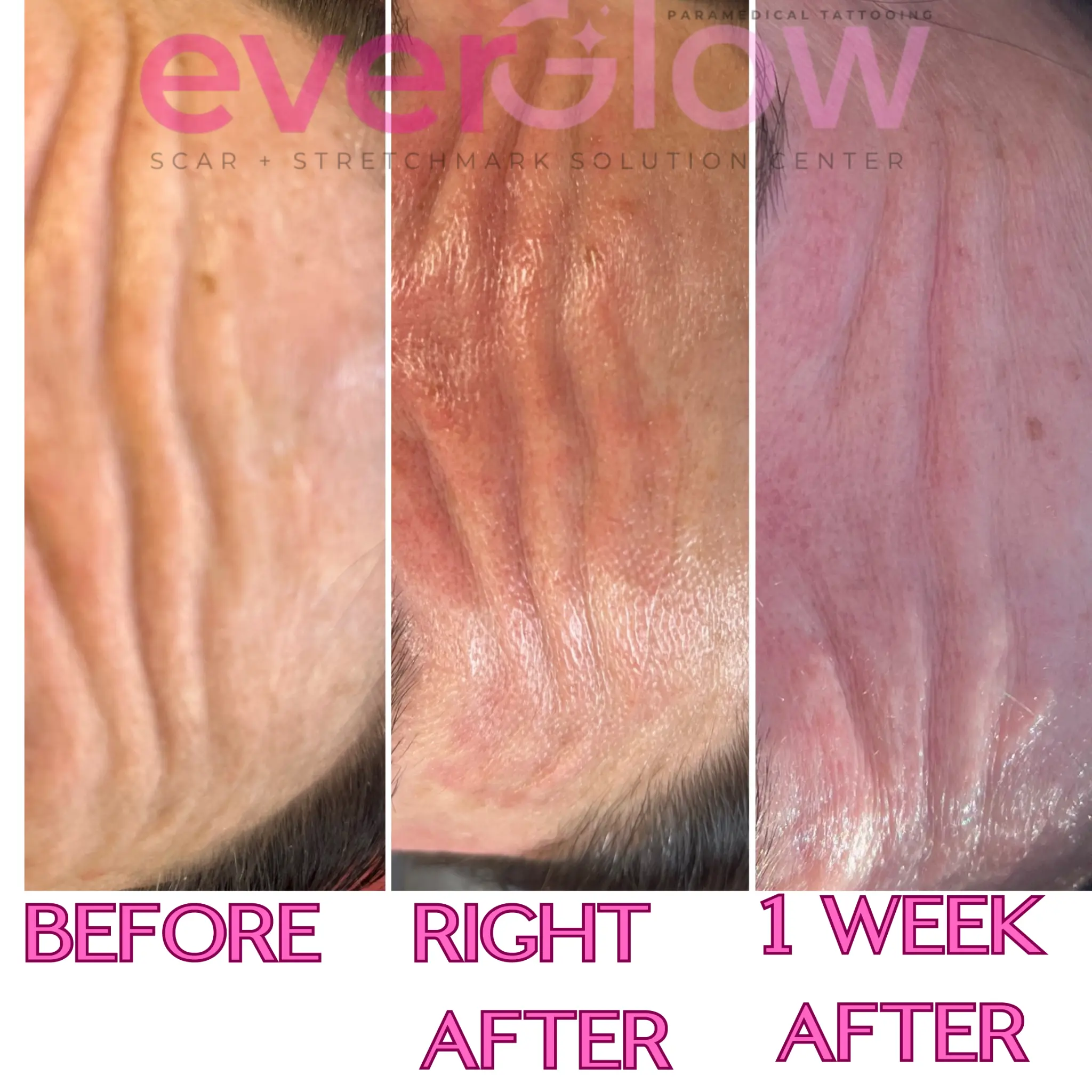 Forehead wrinkle treatment — before and after