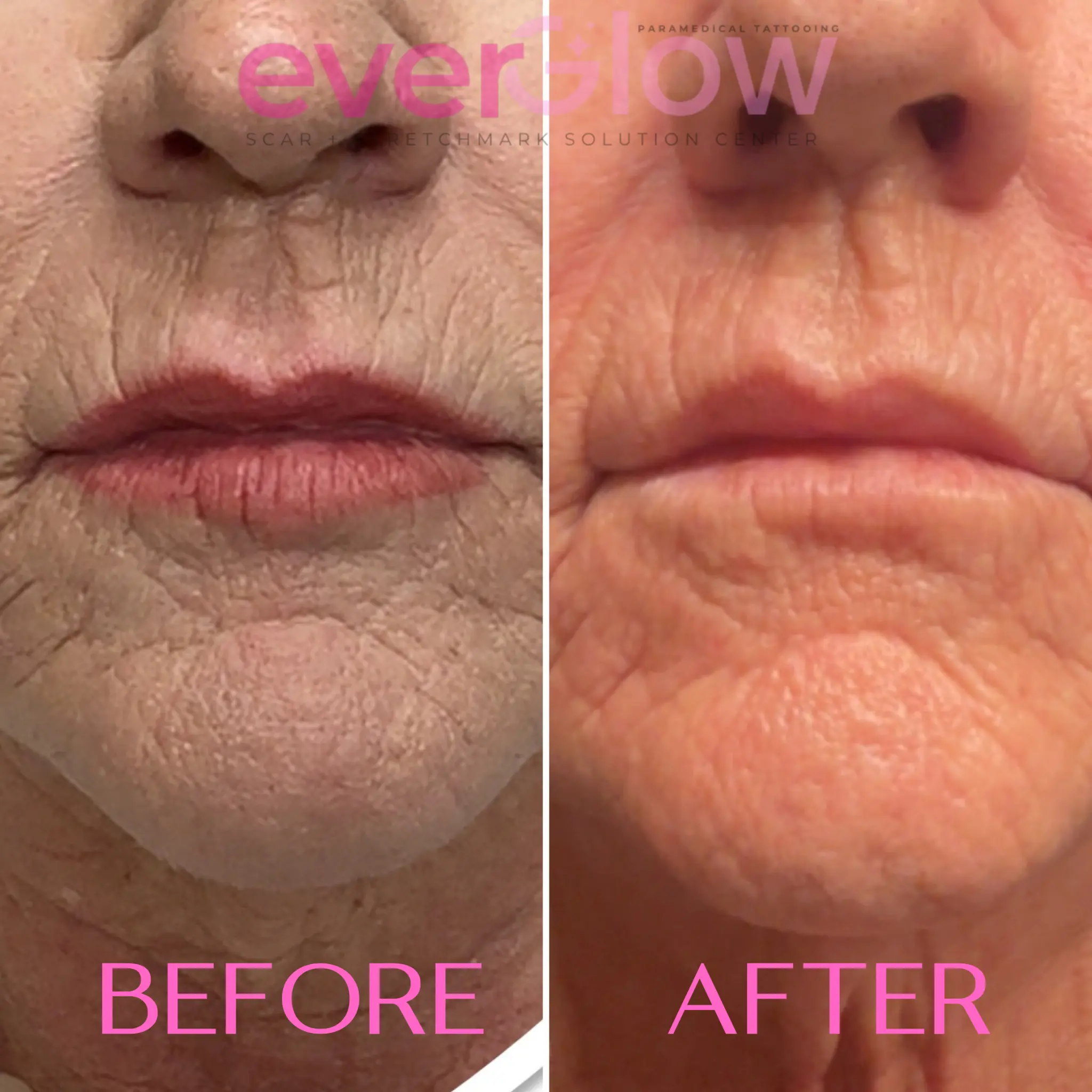 Lip and mouth area inkless treatment — before and after