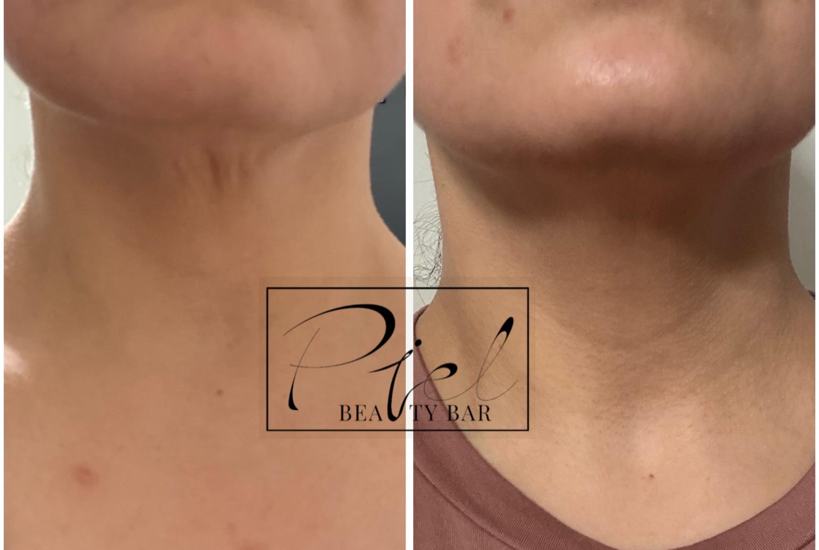 Neck scar camouflage treatment — before and after