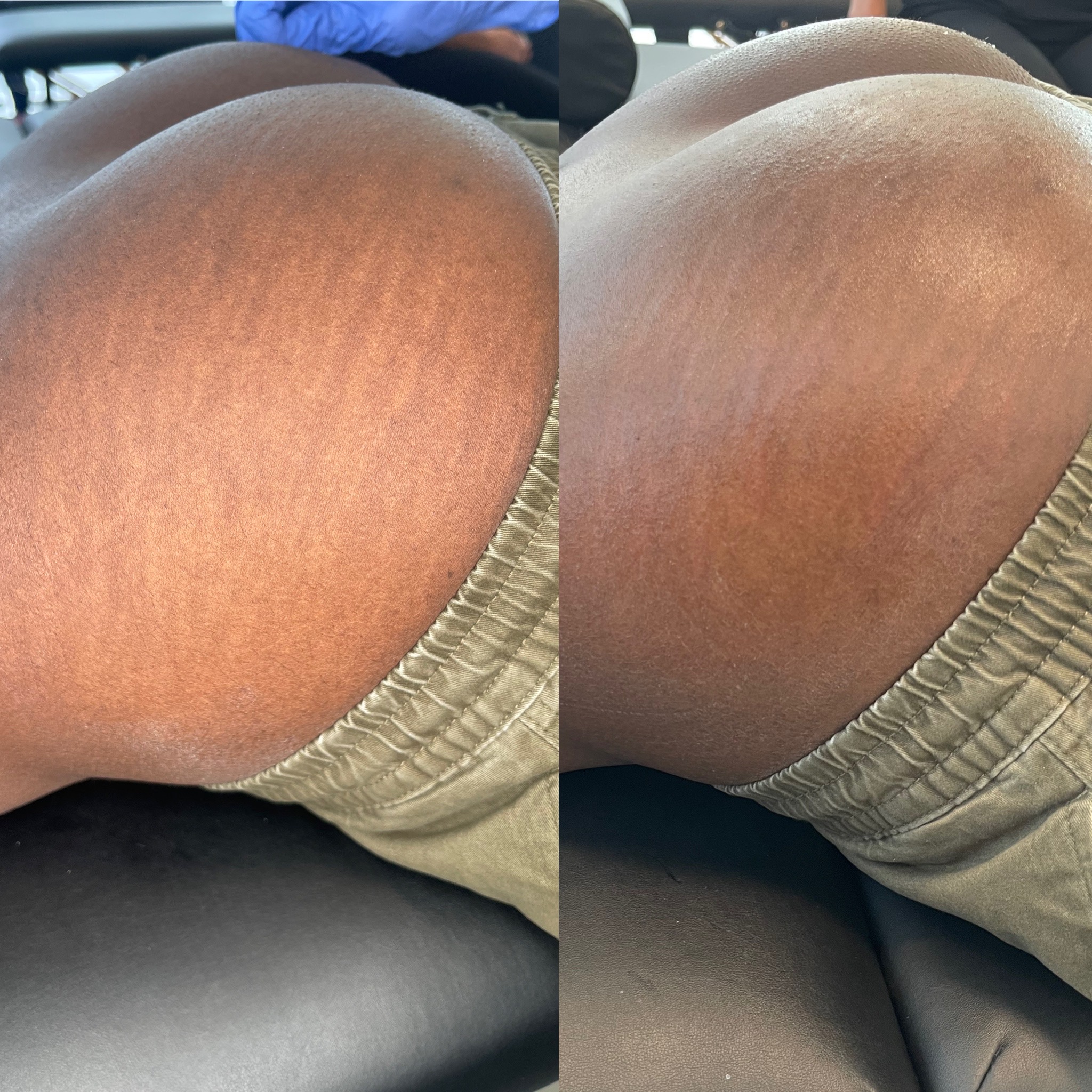 Shoulder stretch mark treatment — before and after