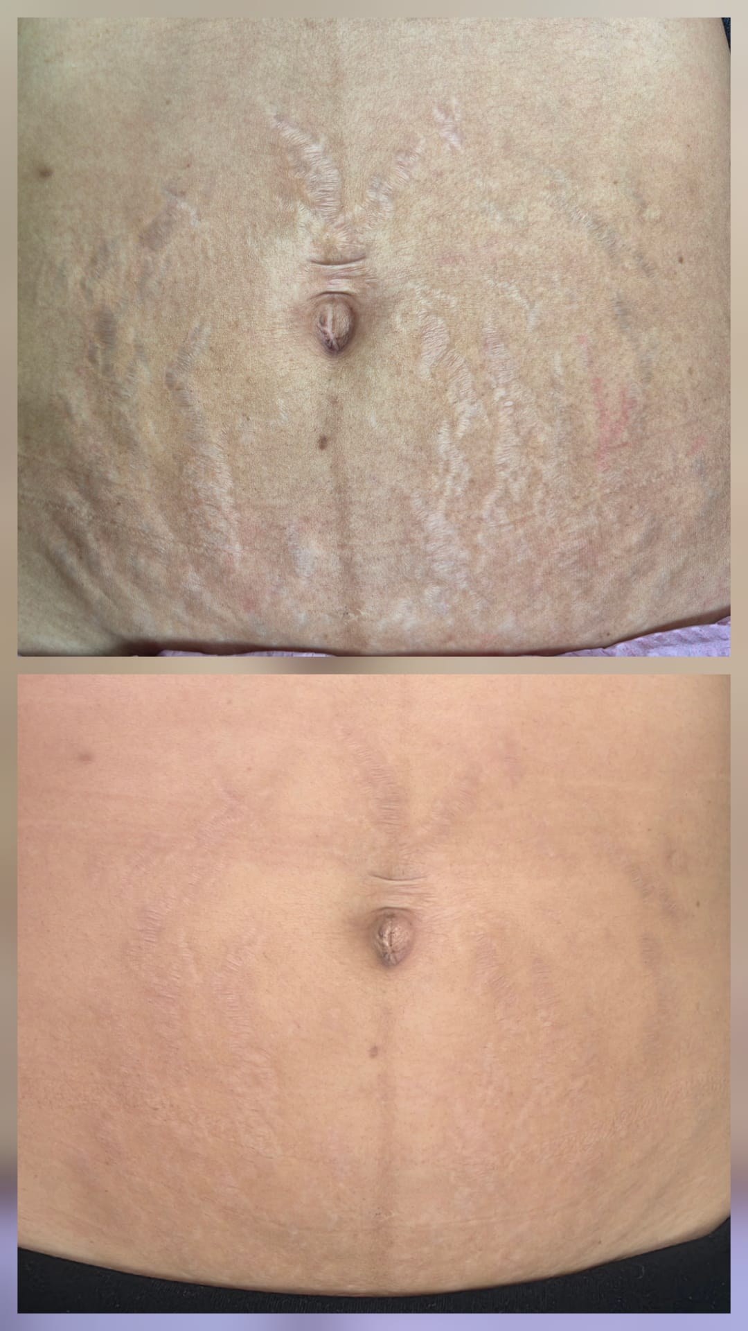 Abdominal stretch mark camouflage — before and after