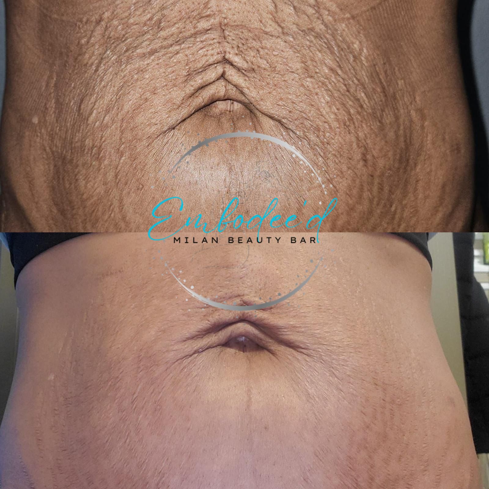 Stretch mark inkless revision — before and after