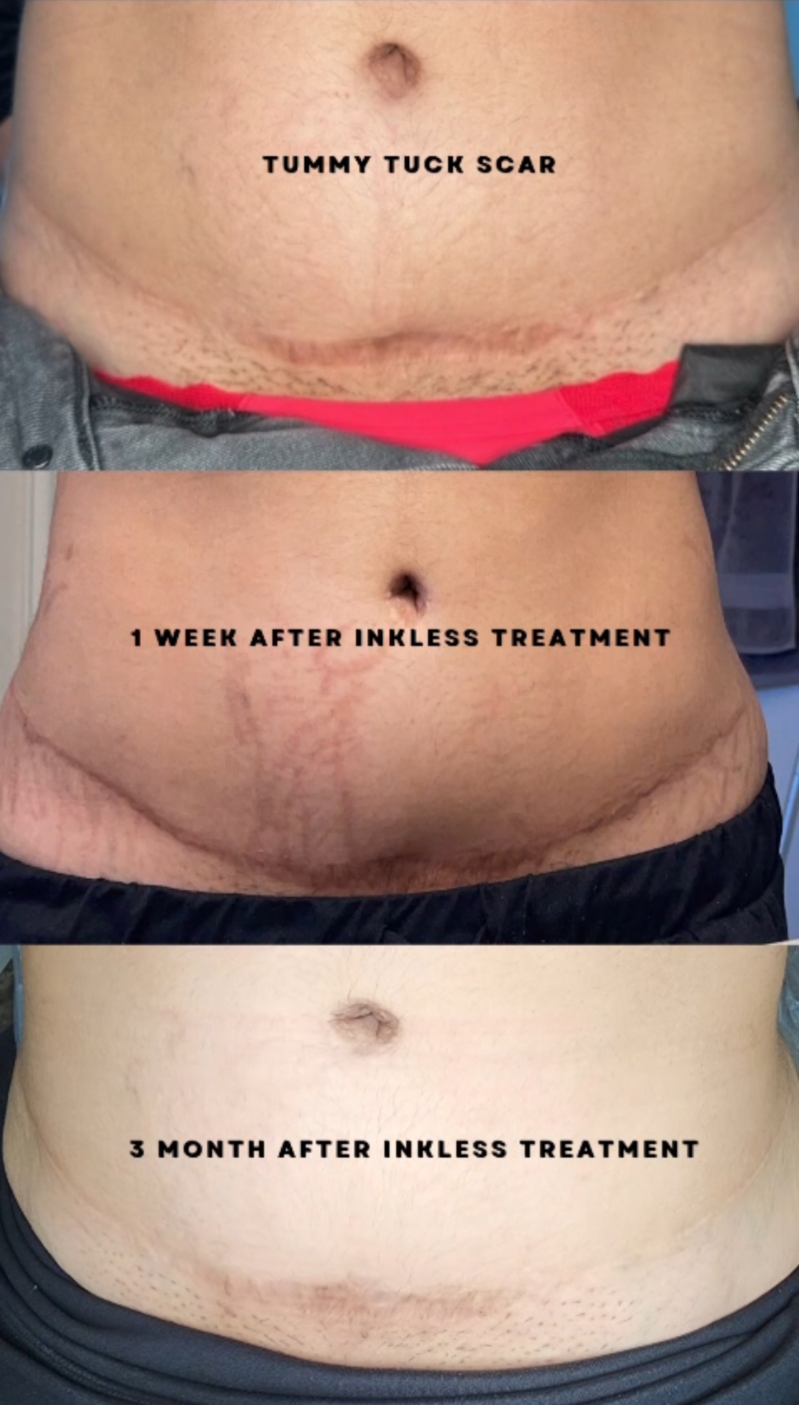Tummy tuck scar — before and after inkless treatment